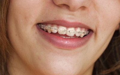 Ultimate Tips for Finding the Best Invisalign Services in Ohio