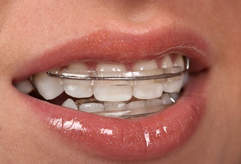 Straighten Your Teeth Without Braces In Medina OH