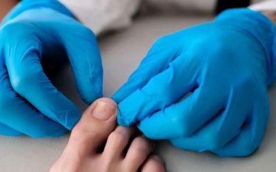 How Ingrown Toenail Removal Works at On Your Feet AZ