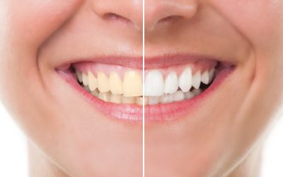 How Restorative Dental Services in Ponchatoula, LA Can Restore Your Confident Smile